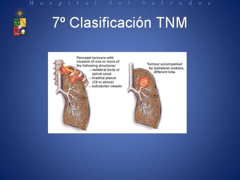 Diapositiva 36 de Cáncer de Pulmón: Diagnóstico y Estadio