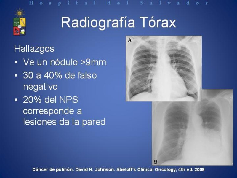 Diapositiva 23 de Cáncer de Pulmón: Diagnóstico y Estadio