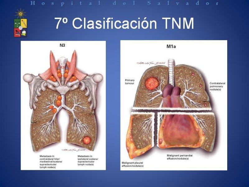Diapositiva 38 de Cáncer de Pulmón: Diagnóstico y Estadio