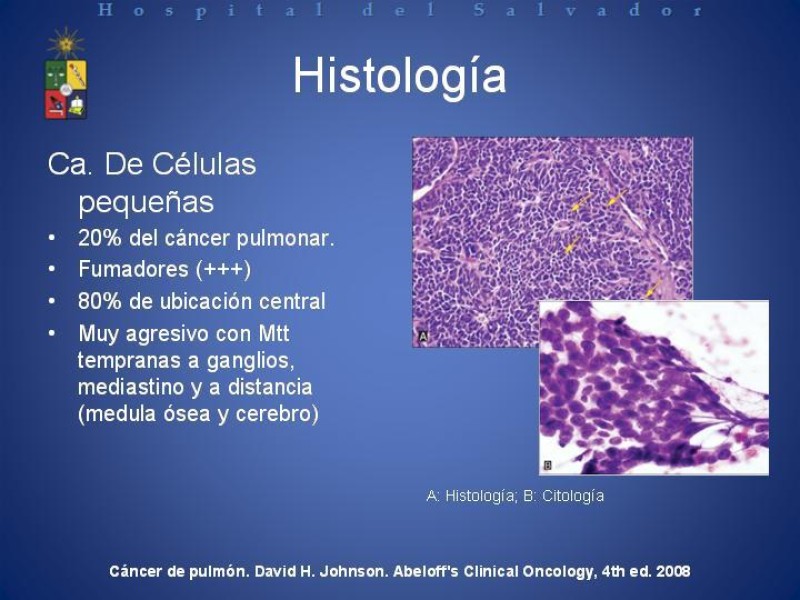 Diapositiva 20 de Cáncer de Pulmón: Diagnóstico y Estadio