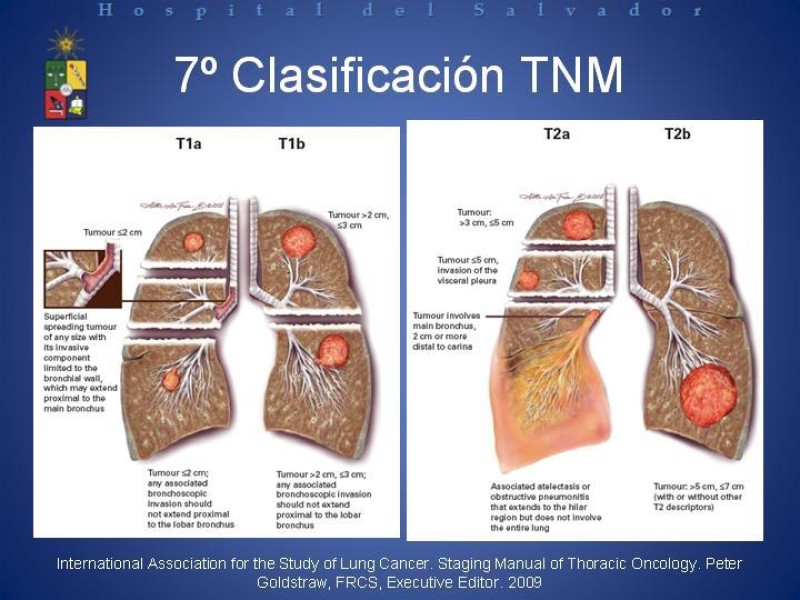 Diapositiva 34 de Cáncer de Pulmón: Diagnóstico y Estadio