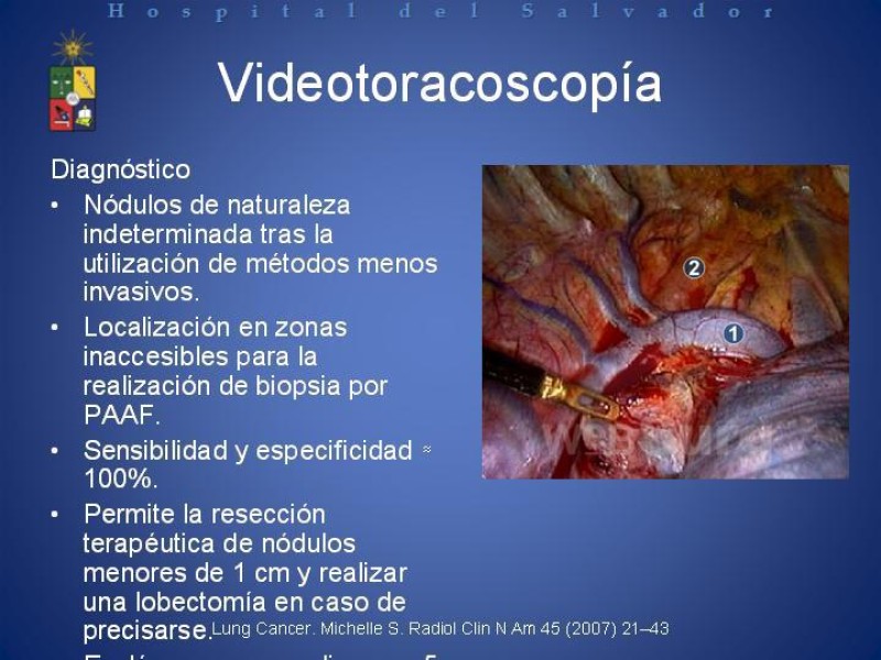 Diapositiva 27 de Cáncer de Pulmón: Diagnóstico y Estadio