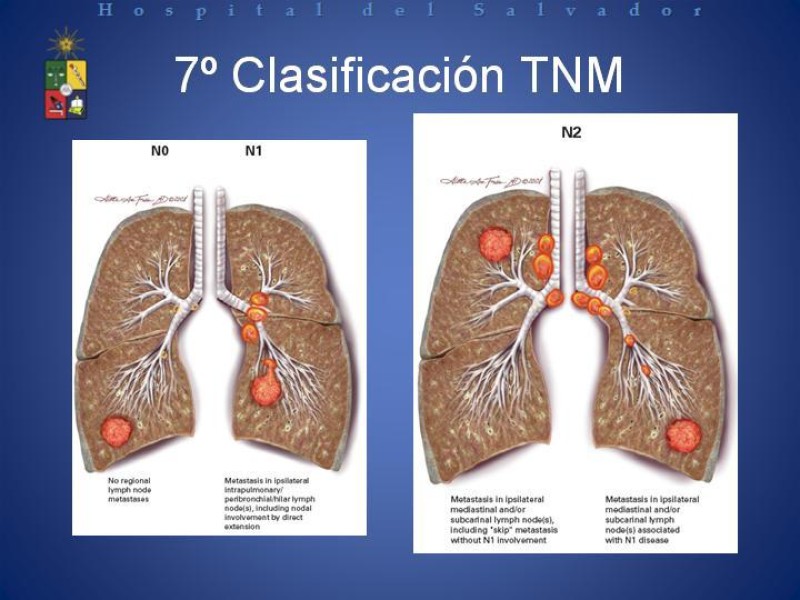 Diapositiva 37 de Cáncer de Pulmón: Diagnóstico y Estadio