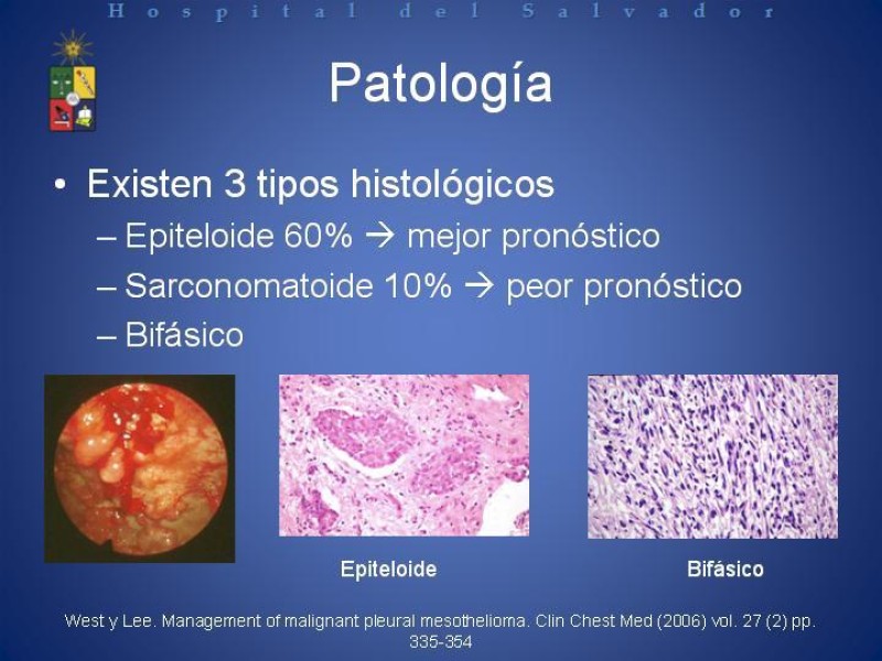 Diapositiva 5 de Mesotelioma Pleural