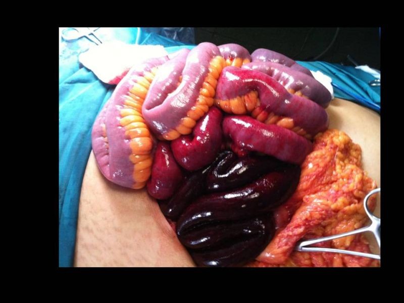 Diapositiva 13 de Complicaciones cirugía bariátrica: Plicatura gástrica ytrombosis portomesentérica 