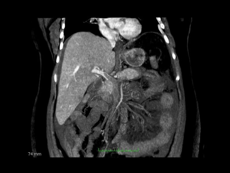 Diapositiva 18 de Complicaciones cirugía bariátrica: Plicatura gástrica ytrombosis portomesentérica 