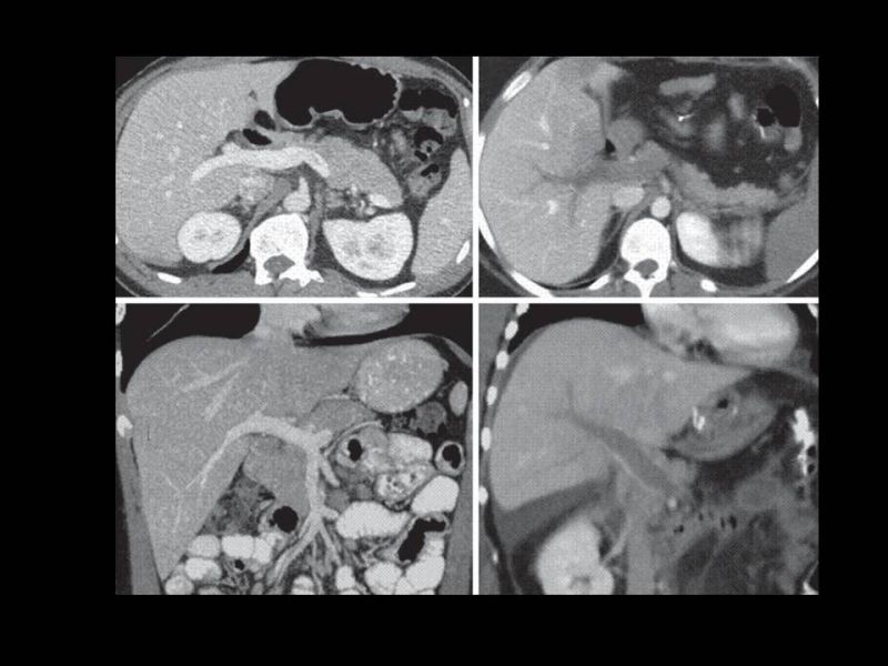 Diapositiva 19 de Complicaciones cirugía bariátrica: Plicatura gástrica ytrombosis portomesentérica 