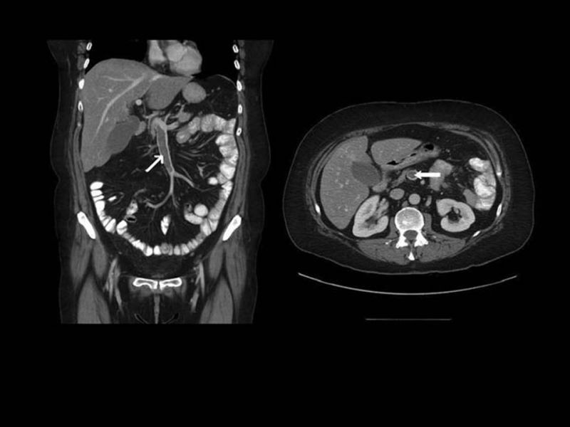 Diapositiva 20 de Complicaciones cirugía bariátrica: Plicatura gástrica ytrombosis portomesentérica 