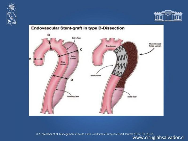 Diapositiva 20 de Manejo Endovascular vs Médico en disección aórtica Tipo B