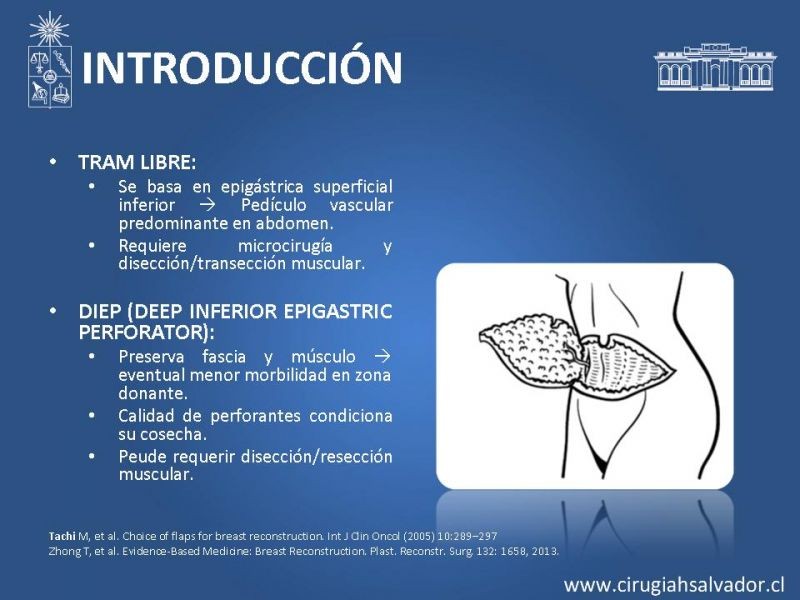 Diapositiva 7 de ¿Qué colgajo utilizar en la reconstrucción mamaria?