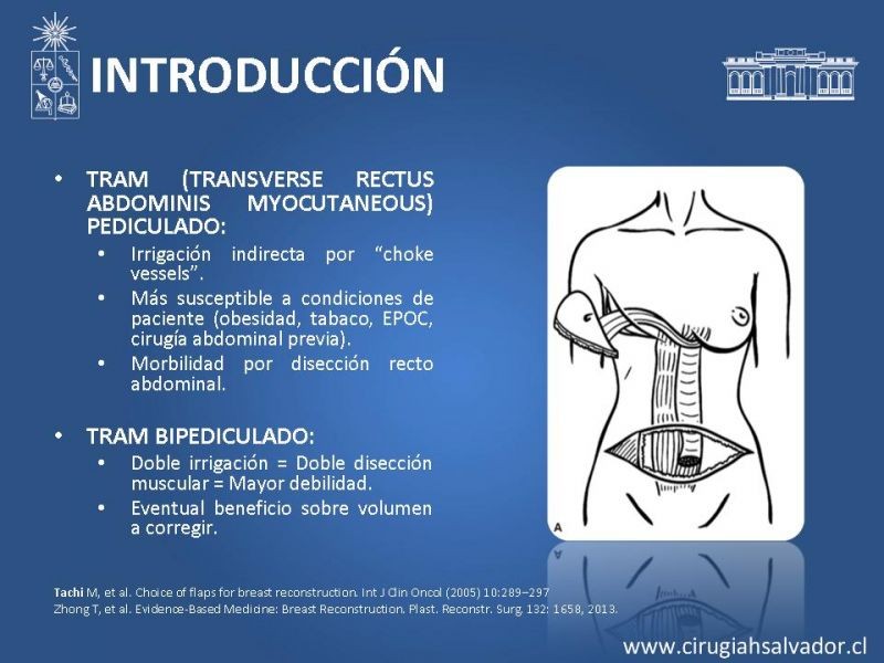 Diapositiva 3 de ¿Qué colgajo utilizar en la reconstrucción mamaria?
