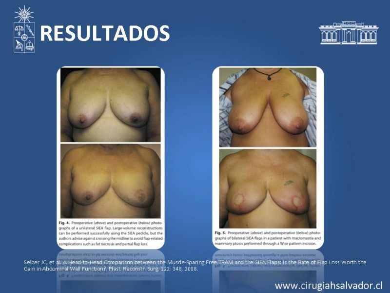 Diapositiva 25 de ¿Qué colgajo utilizar en la reconstrucción mamaria?
