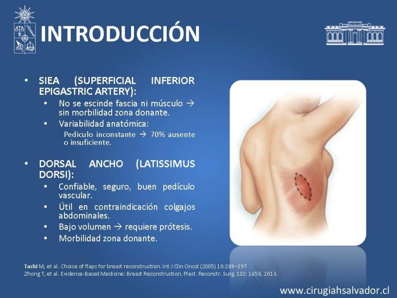 Diapositiva 9 de ¿Qué colgajo utilizar en la reconstrucción mamaria?
