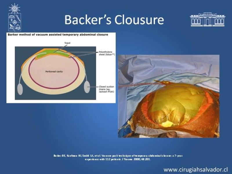 Diapositiva 15 de Open Abdomen (Laparostomía Contenida)