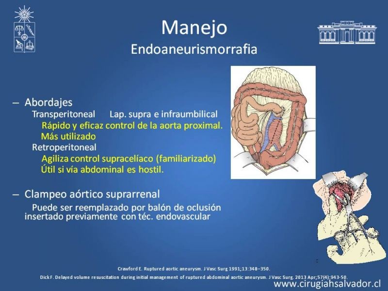 Diapositiva 26 de Aneurisma Aórtico Abdominal Roto