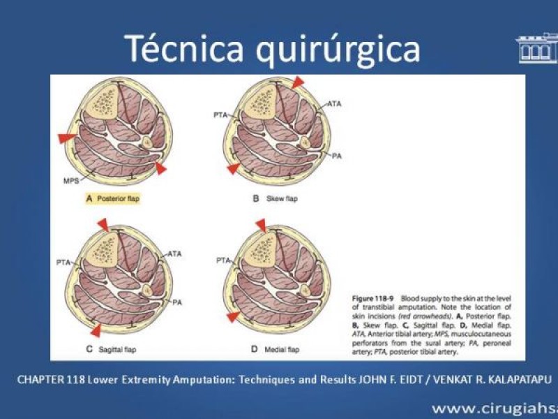Diapositiva 14 de Amputación infracondilea