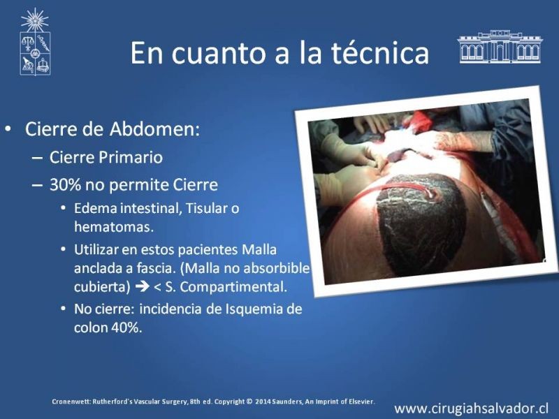 Diapositiva 32 de Aneurisma Aórtico Abdominal Roto