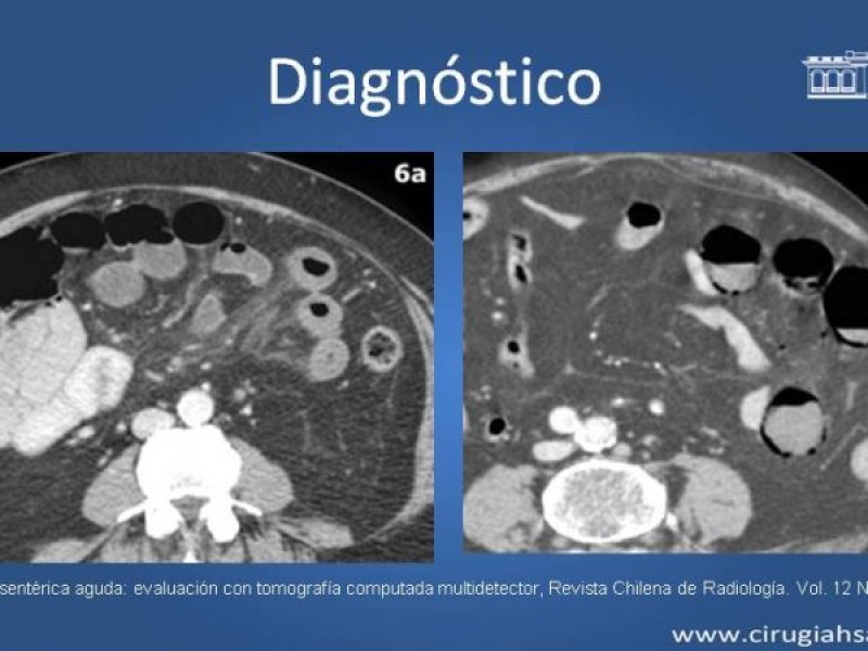 Diapositiva 21 de Trombosis de vena mesentérica