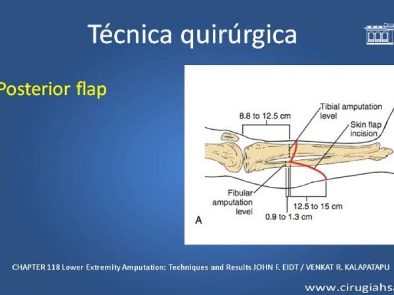Diapositiva 15 de Amputación infracondilea