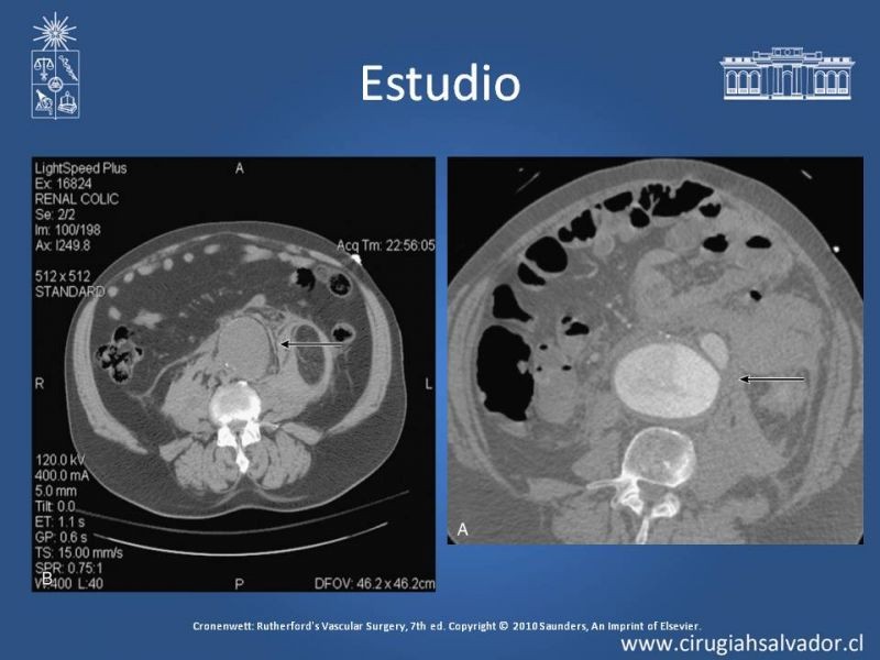 Diapositiva 17 de Aneurisma Aórtico Abdominal Roto