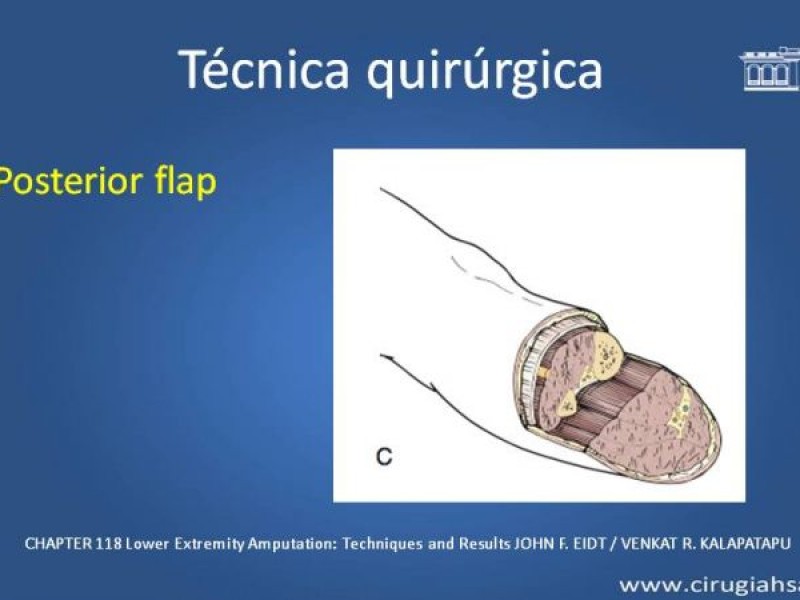 Diapositiva 17 de Amputación infracondilea