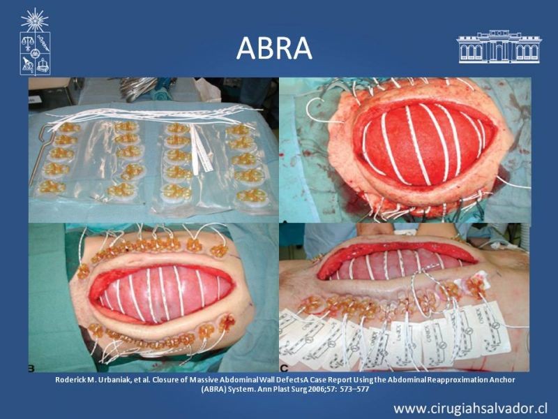 Diapositiva 25 de Alternativas de Cobertura en Abdomen Abierto
