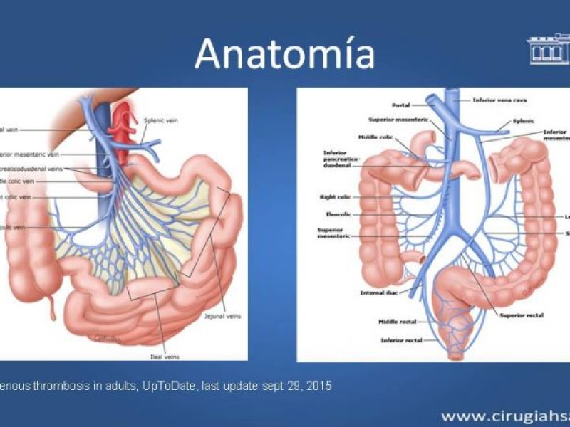 Diapositiva 5 de Trombosis de vena mesentérica