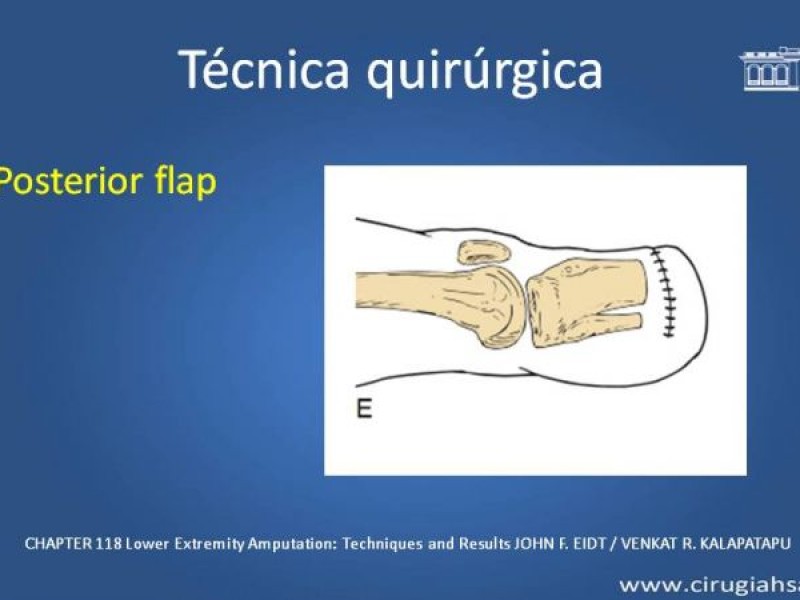 Diapositiva 19 de Amputación infracondilea