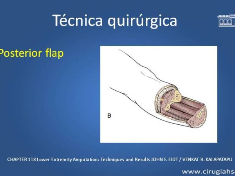 Diapositiva 16 de Amputación infracondilea
