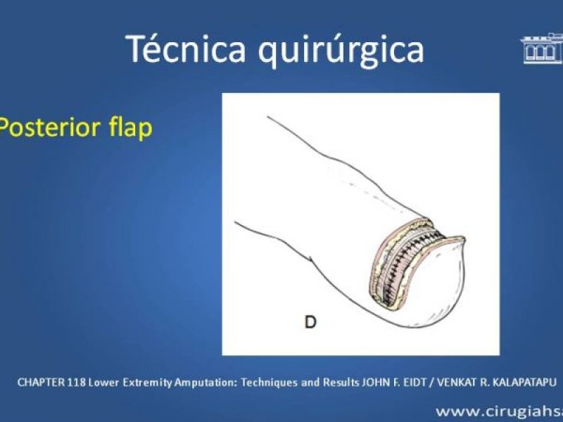 Diapositiva 18 de Amputación infracondilea