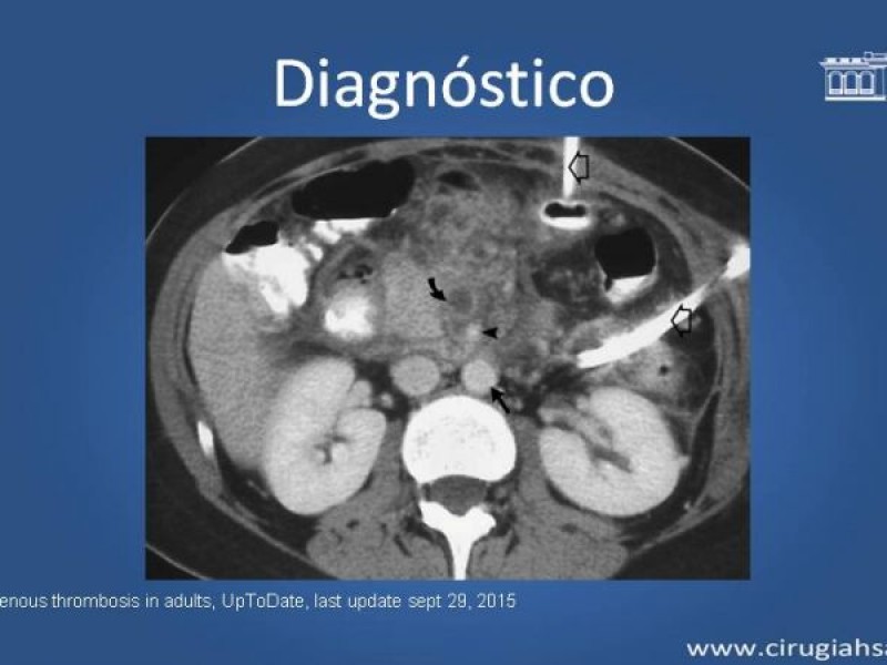 Diapositiva 20 de Trombosis de vena mesentérica