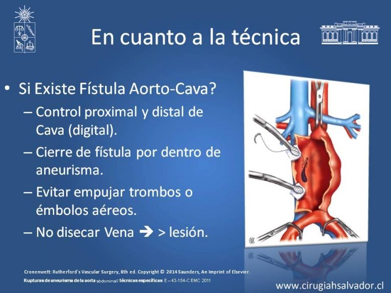 Diapositiva 30 de Aneurisma Aórtico Abdominal Roto