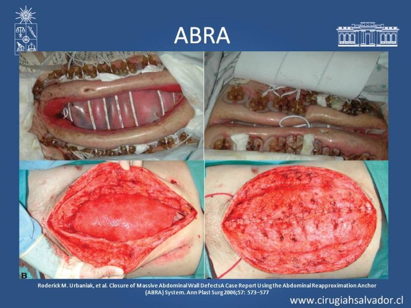 Diapositiva 26 de Alternativas de Cobertura en Abdomen Abierto