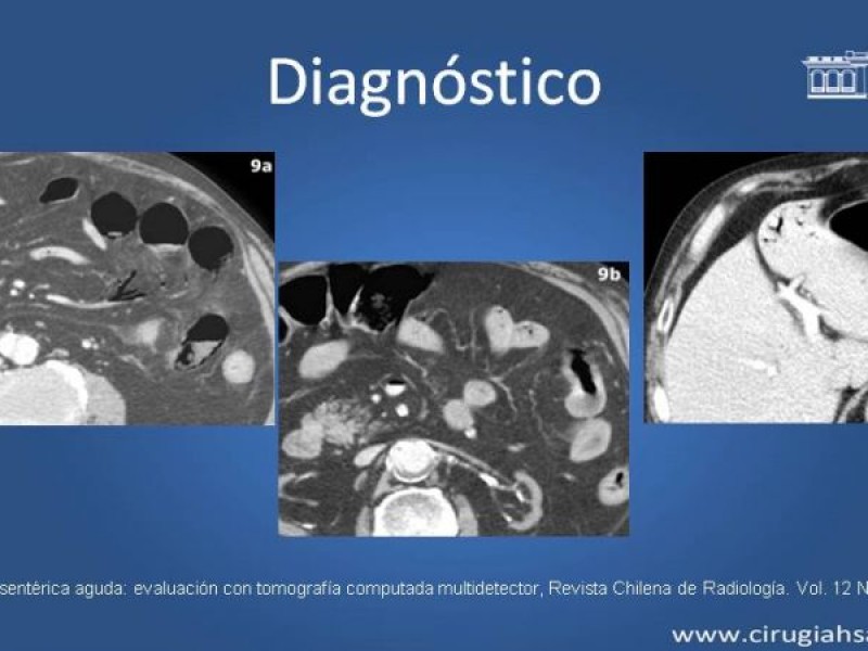 Diapositiva 22 de Trombosis de vena mesentérica