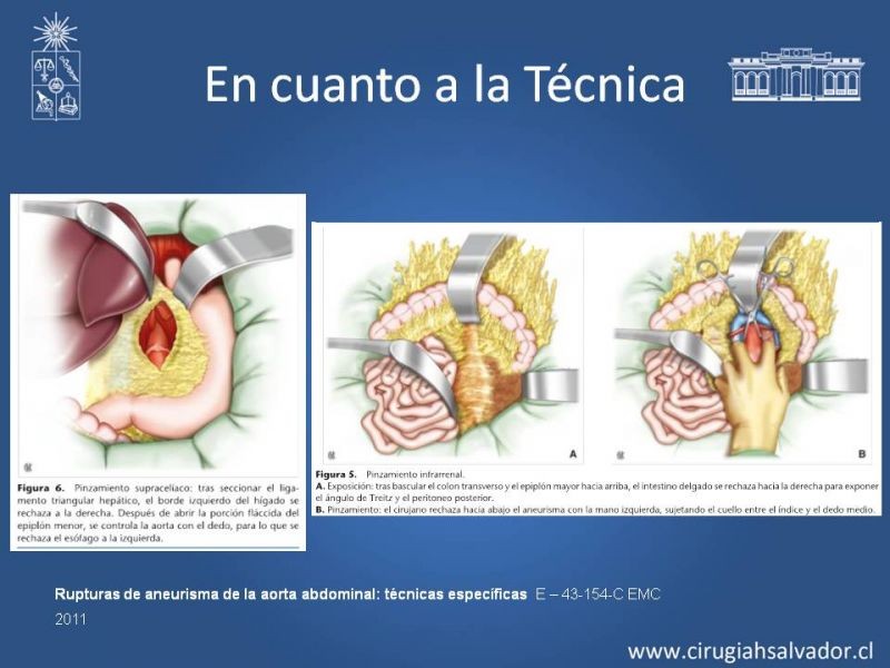 Diapositiva 28 de Aneurisma Aórtico Abdominal Roto
