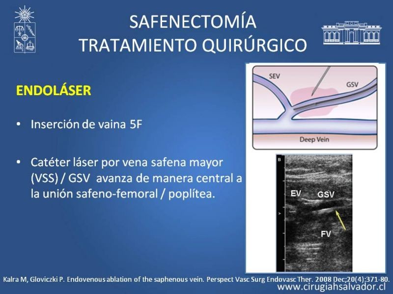 Diapositiva 23 de Safenectomía: técnica y resultados a largo plazo