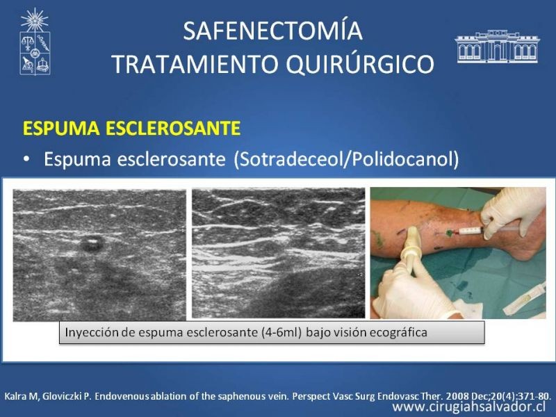 Diapositiva 34 de Safenectomía: técnica y resultados a largo plazo