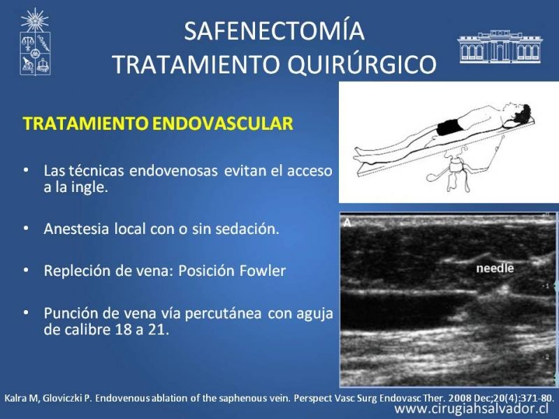 Diapositiva 22 de Safenectomía: técnica y resultados a largo plazo