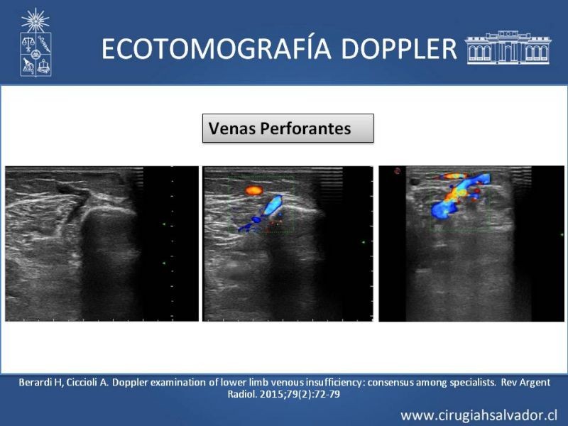 Diapositiva 13 de Safenectomía: técnica y resultados a largo plazo