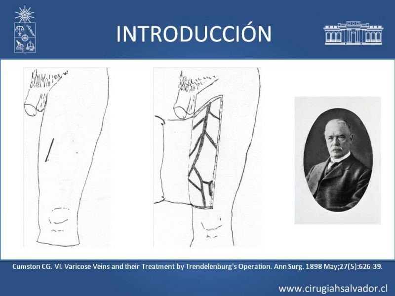 Diapositiva 2 de Safenectomía: técnica y resultados a largo plazo