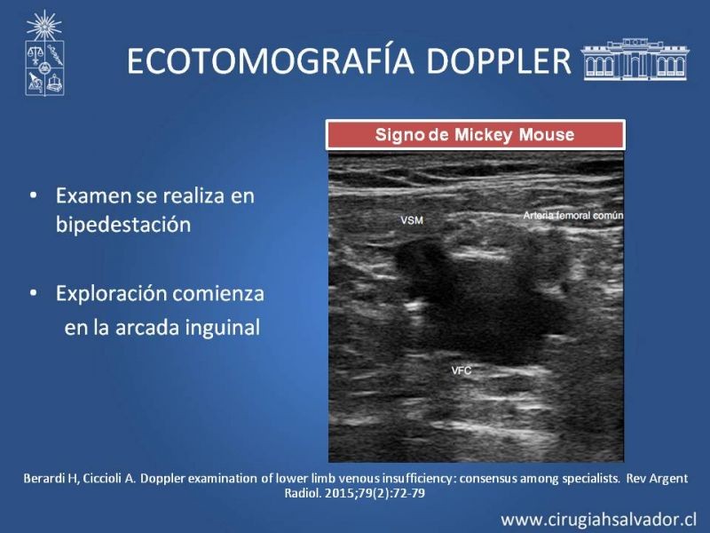 Diapositiva 8 de Safenectomía: técnica y resultados a largo plazo