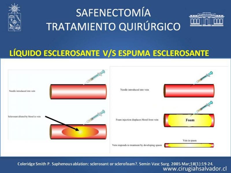 Diapositiva 31 de Safenectomía: técnica y resultados a largo plazo