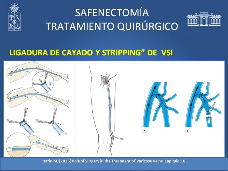 Diapositiva 17 de Safenectomía: técnica y resultados a largo plazo