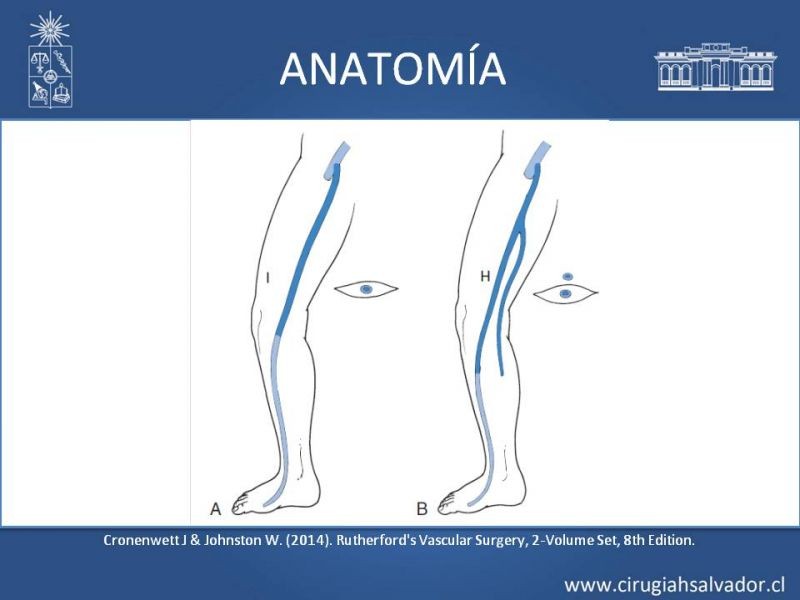 Diapositiva 7 de Safenectomía: técnica y resultados a largo plazo
