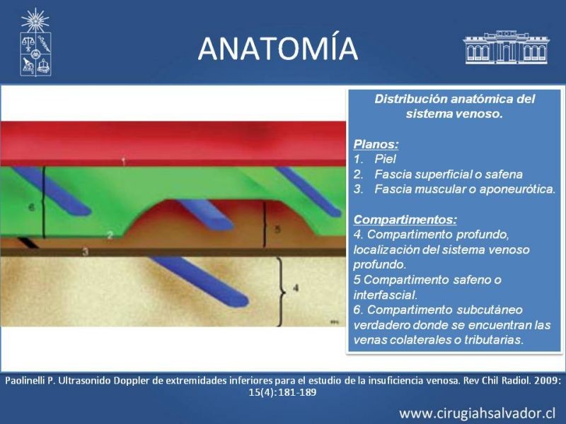 Diapositiva 4 de Safenectomía: técnica y resultados a largo plazo