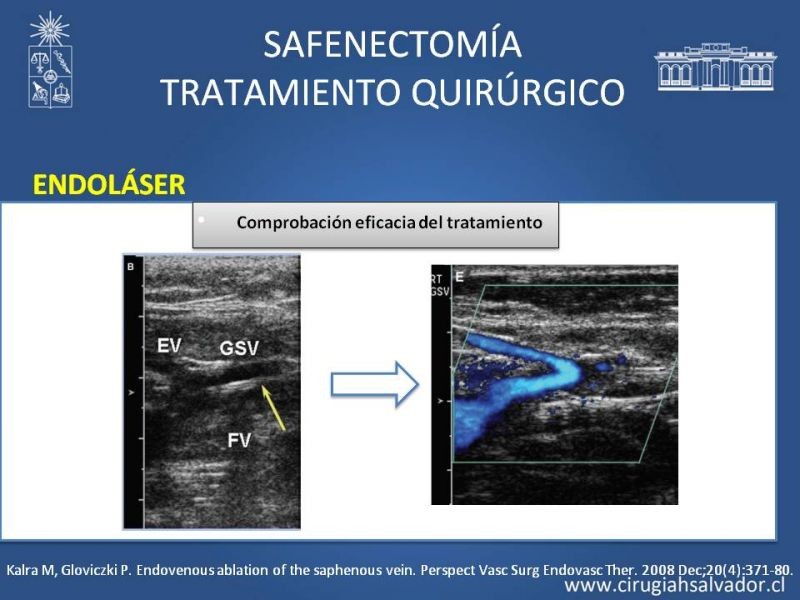 Diapositiva 26 de Safenectomía: técnica y resultados a largo plazo