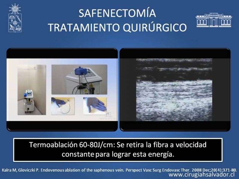 Diapositiva 25 de Safenectomía: técnica y resultados a largo plazo