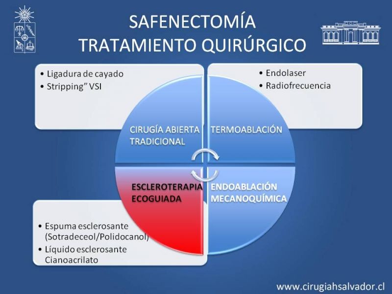 Diapositiva 30 de Safenectomía: técnica y resultados a largo plazo