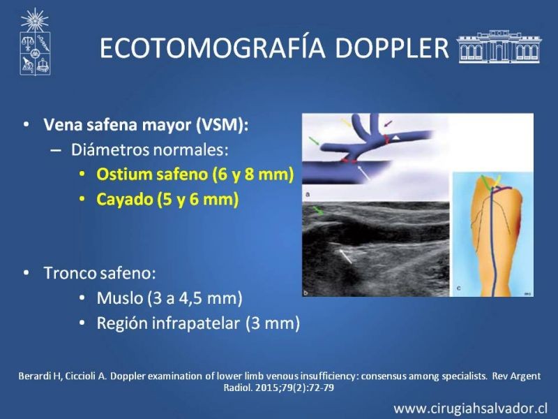 Diapositiva 9 de Safenectomía: técnica y resultados a largo plazo