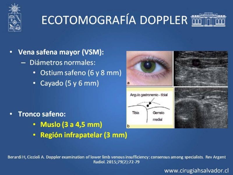 Diapositiva 11 de Safenectomía: técnica y resultados a largo plazo
